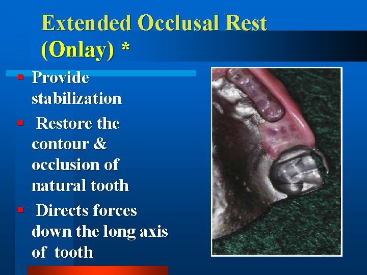Extended Occlusal Rest (Onlay) * § Provide stabilization § Restore the contour & occlusion