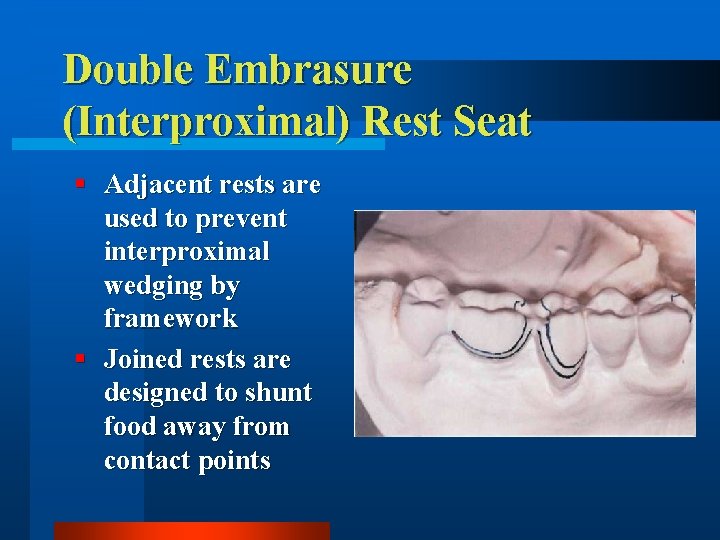 Double Embrasure (Interproximal) Rest Seat § Adjacent rests are used to prevent interproximal wedging