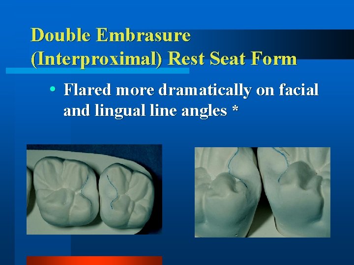 Double Embrasure (Interproximal) Rest Seat Form Flared more dramatically on facial and lingual line