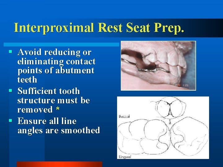 Interproximal Rest Seat Prep. § Avoid reducing or eliminating contact points of abutment teeth