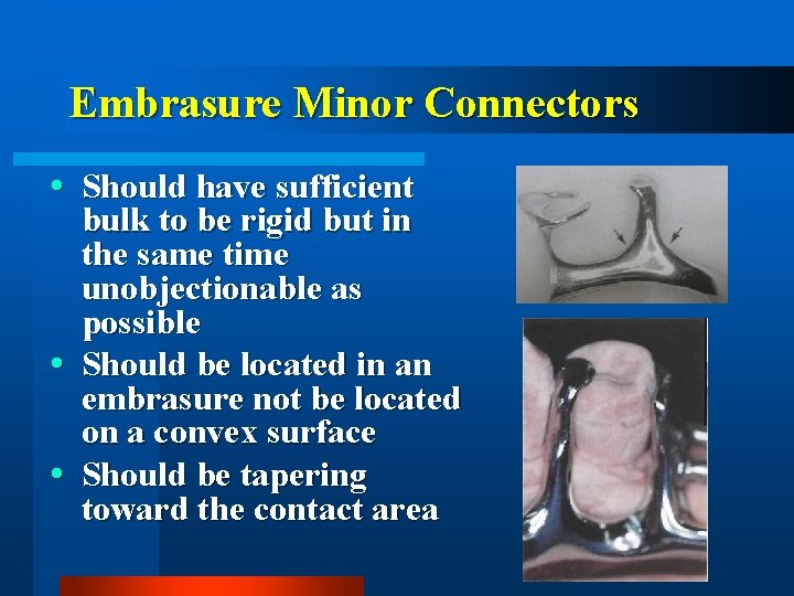 Embrasure Minor Connectors Should have sufficient bulk to be rigid but in the same