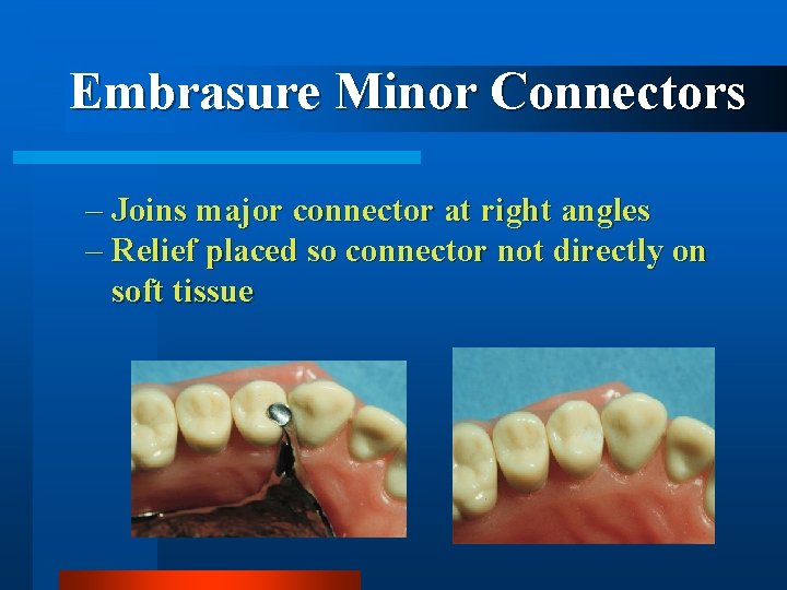 Embrasure Minor Connectors – Joins major connector at right angles – Relief placed so