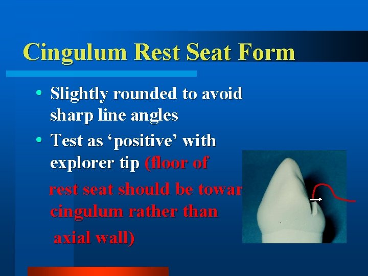 Cingulum Rest Seat Form Slightly rounded to avoid sharp line angles Test as ‘positive’