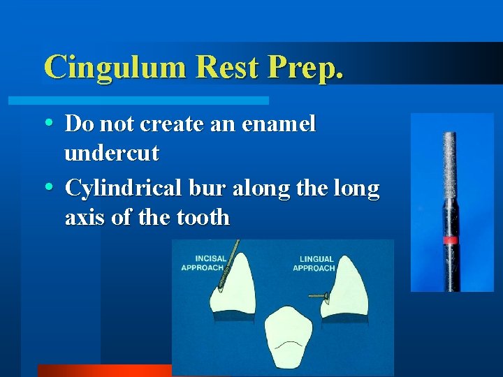 Cingulum Rest Prep. Do not create an enamel undercut Cylindrical bur along the long