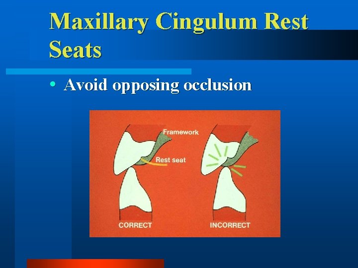Maxillary Cingulum Rest Seats Avoid opposing occlusion 