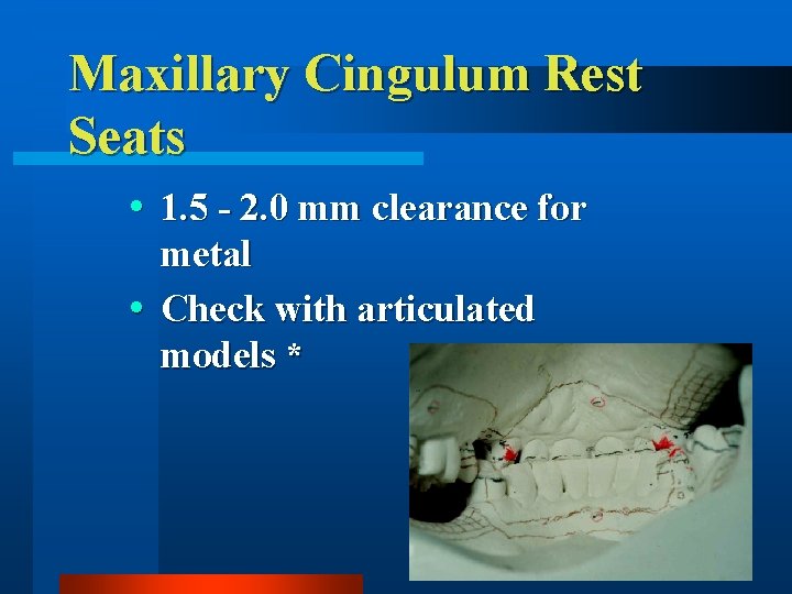 Maxillary Cingulum Rest Seats 1. 5 - 2. 0 mm clearance for metal Check