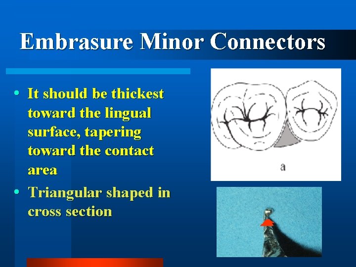 Embrasure Minor Connectors It should be thickest toward the lingual surface, tapering toward the