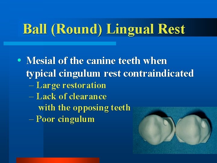 Ball (Round) Lingual Rest Mesial of the canine teeth when typical cingulum rest contraindicated