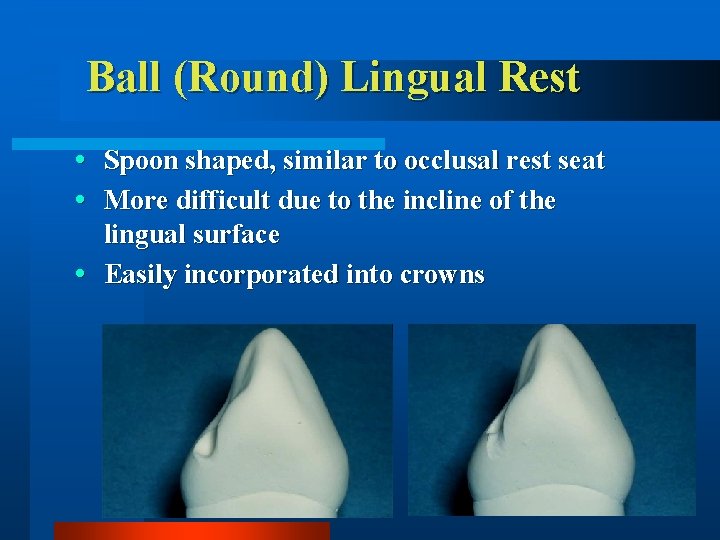 Ball (Round) Lingual Rest Spoon shaped, similar to occlusal rest seat More difficult due