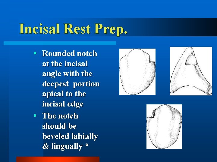 Incisal Rest Prep. Rounded notch at the incisal angle with the deepest portion apical