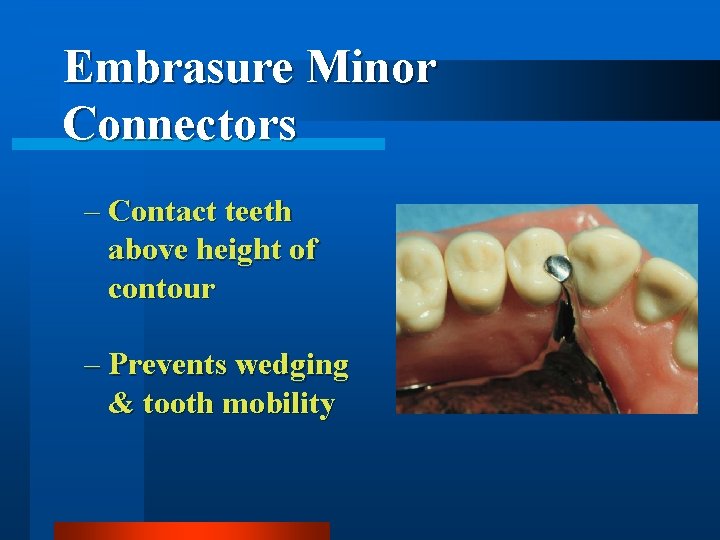 Embrasure Minor Connectors – Contact teeth above height of contour – Prevents wedging &