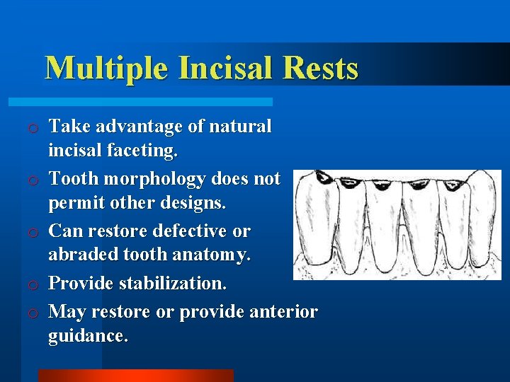 Multiple Incisal Rests o Take advantage of natural incisal faceting. o Tooth morphology does
