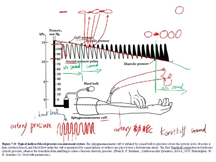 Figure 7. 20 Typical indirect blood-pressure measurement system The sphygmomanometer cuff is inflated by