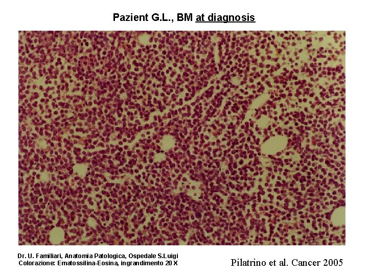 Pazient G. L. , BM at diagnosis Dr. U. Familiari, Anatomia Patologica, Ospedale S.