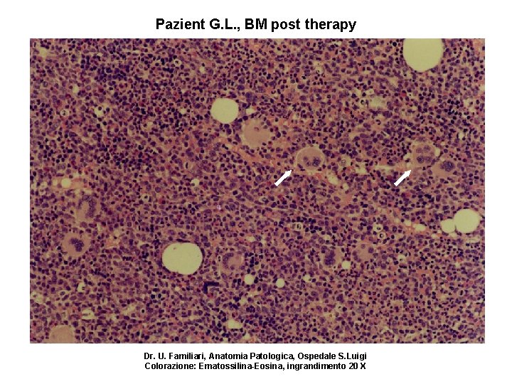 Pazient G. L. , BM post therapy Dr. U. Familiari, Anatomia Patologica, Ospedale S.