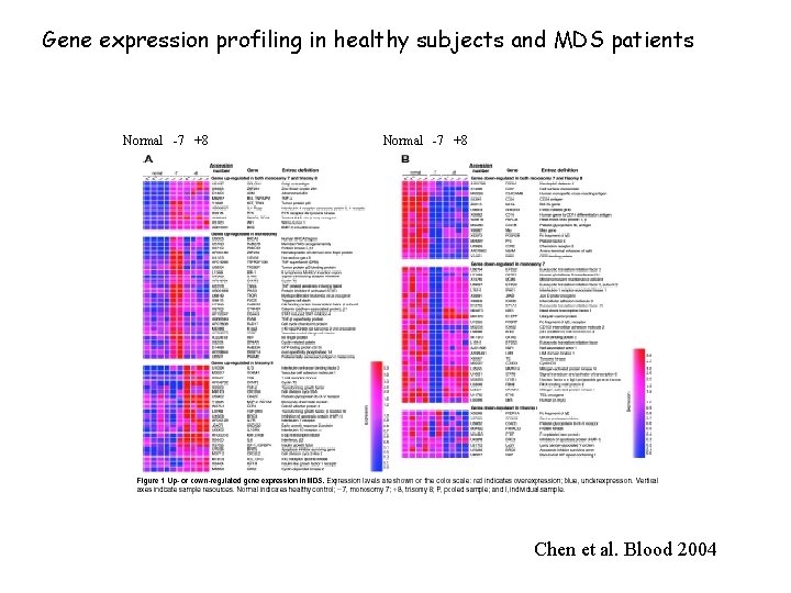 Gene expression profiling in healthy subjects and MDS patients Normal -7 +8 Chen et