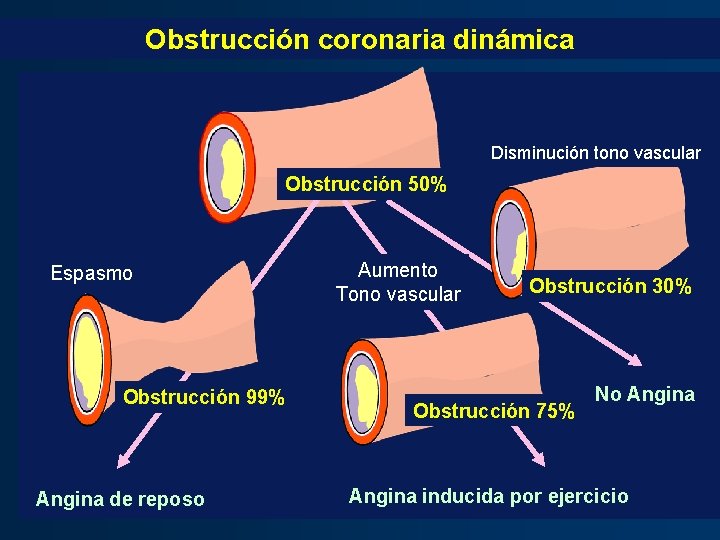 Obstrucción coronaria dinámica Disminución tono vascular Obstrucción 50% Espasmo Obstrucción 99% Angina de reposo