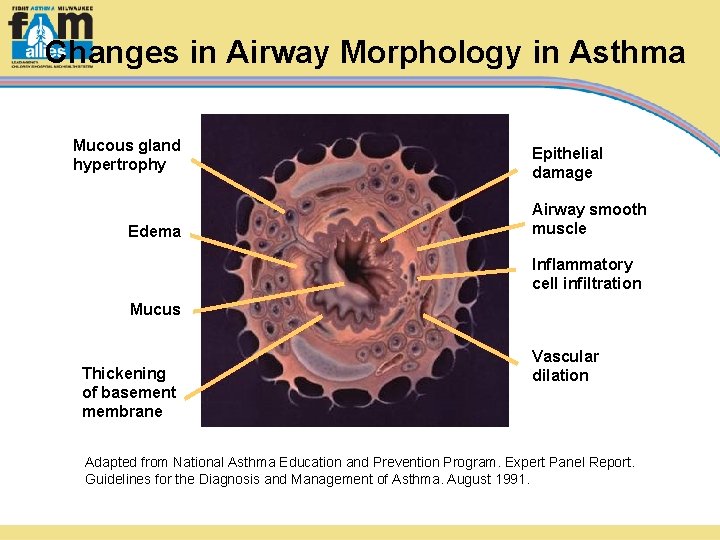 Changes in Airway Morphology in Asthma Mucous gland hypertrophy Edema Epithelial damage Airway smooth