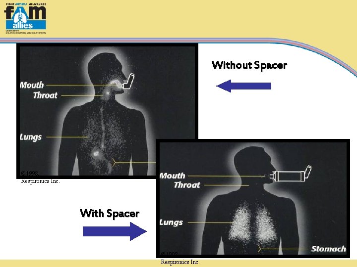 Without Spacer © 1998, Respironics Inc. With Spacer © 1998, Respironics Inc. 