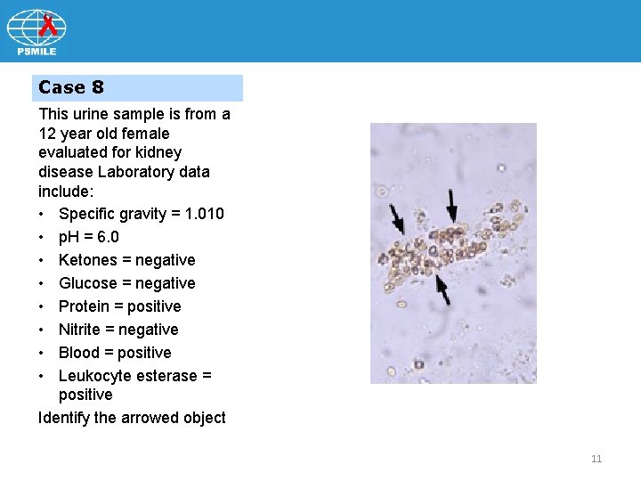 Case 8 This urine sample is from a 12 year old female evaluated for