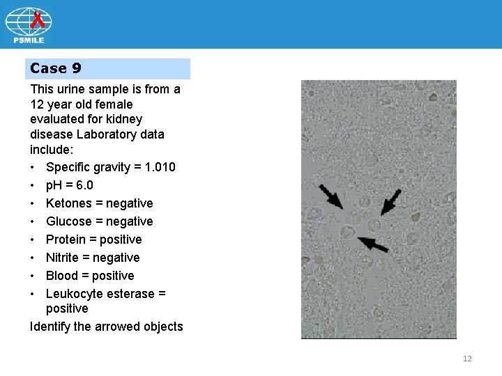 Case 9 This urine sample is from a 12 year old female evaluated for