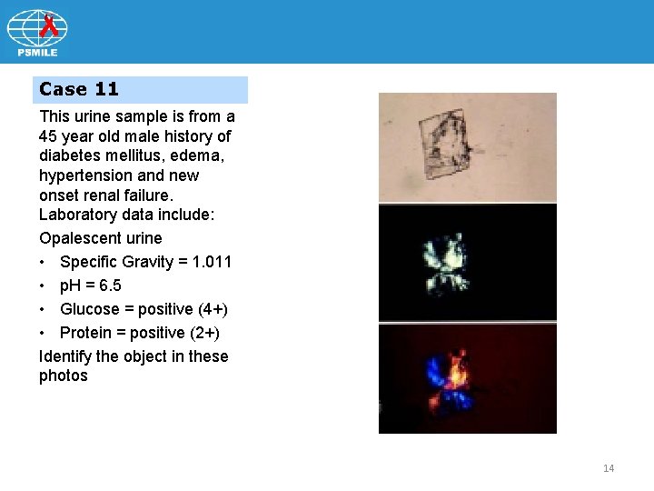 Case 11 This urine sample is from a 45 year old male history of