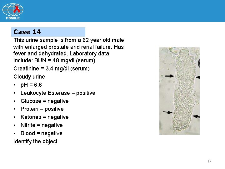 Case 14 This urine sample is from a 62 year old male with enlarged