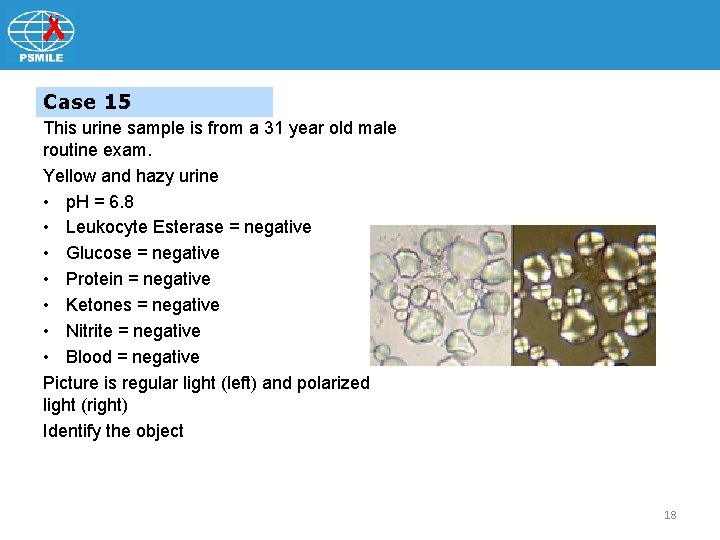 Case 15 This urine sample is from a 31 year old male routine exam.