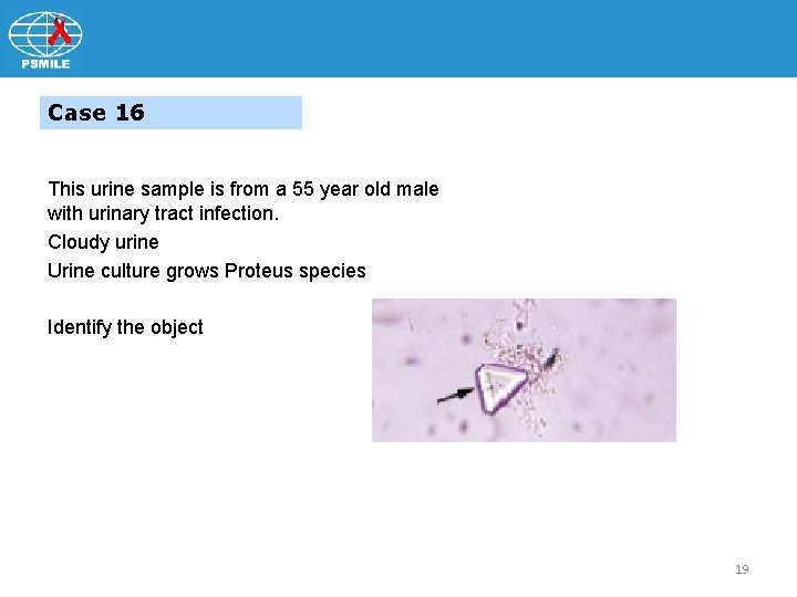 Case 16 This urine sample is from a 55 year old male with urinary