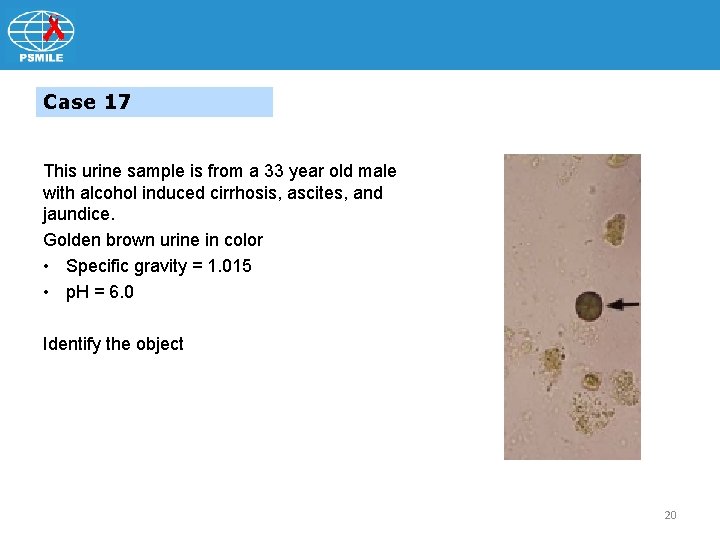 Case 17 This urine sample is from a 33 year old male with alcohol