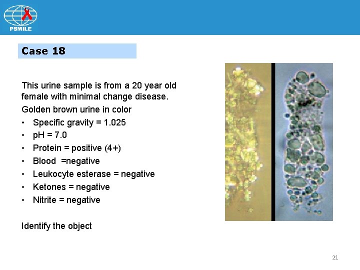 Case 18 This urine sample is from a 20 year old female with minimal