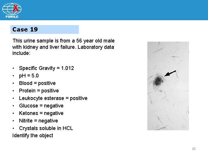 Case 19 This urine sample is from a 56 year old male with kidney