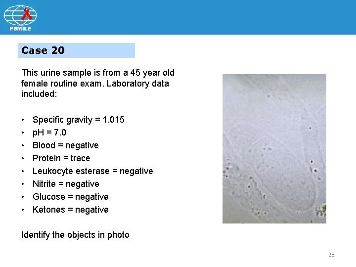 Case 20 This urine sample is from a 45 year old female routine exam.