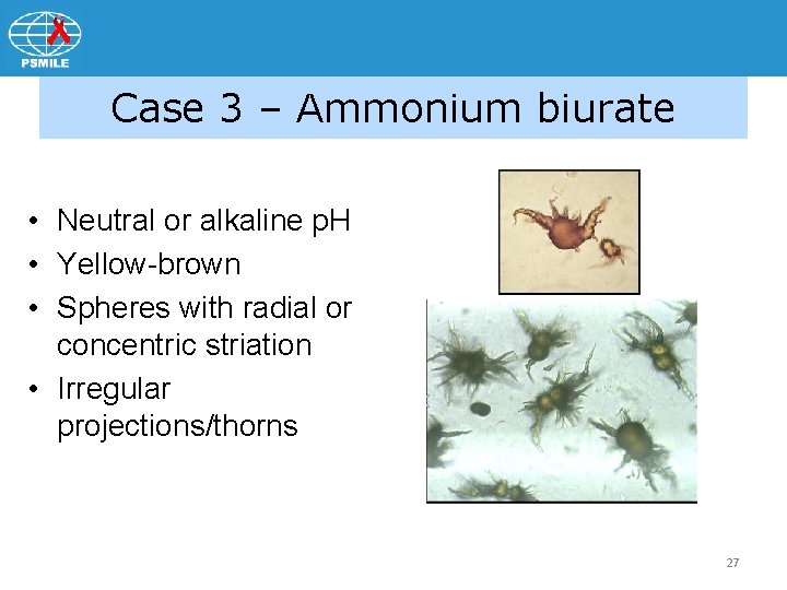 Case 3 – Ammonium biurate • Neutral or alkaline p. H • Yellow-brown •