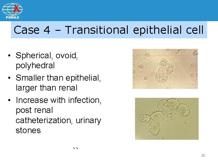 Case 4 – Transitional epithelial cell • Spherical, ovoid, polyhedral • Smaller than epithelial,