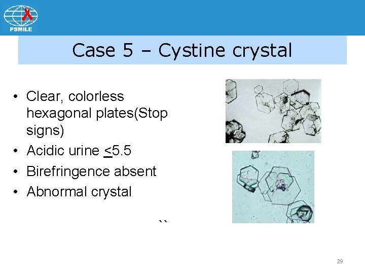 Case 5 – Cystine crystal • Clear, colorless hexagonal plates(Stop signs) • Acidic urine