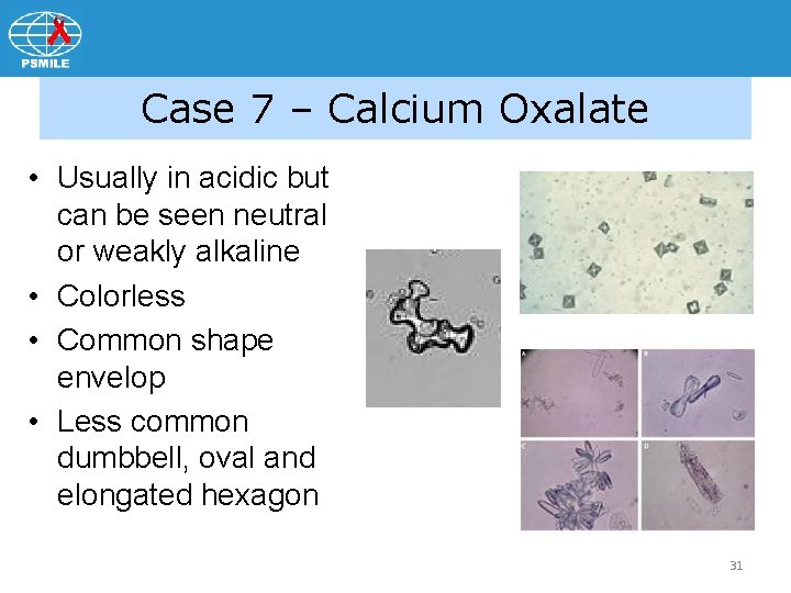 Case 7 – Calcium Oxalate • Usually in acidic but can be seen neutral