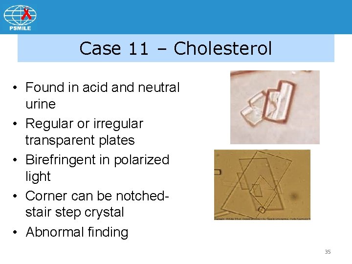 Case 11 – Cholesterol • Found in acid and neutral urine • Regular or
