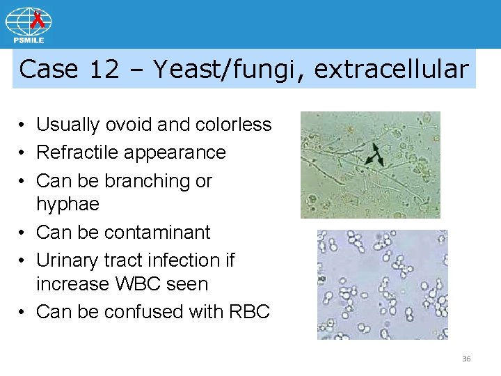 Case 12 – Yeast/fungi, extracellular • Usually ovoid and colorless • Refractile appearance •