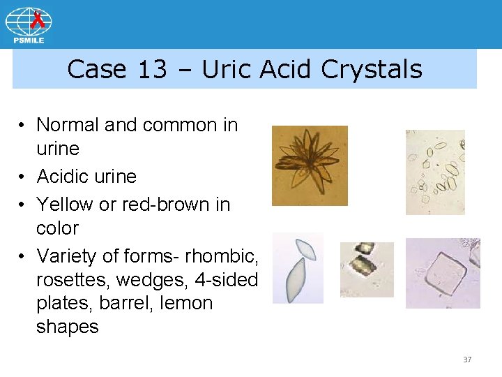 Case 13 – Uric Acid Crystals • Normal and common in urine • Acidic
