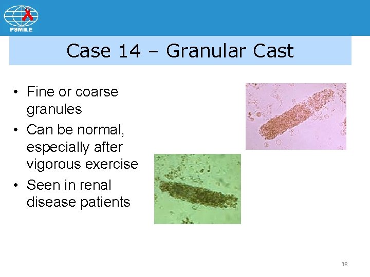 Case 14 – Granular Cast • Fine or coarse granules • Can be normal,