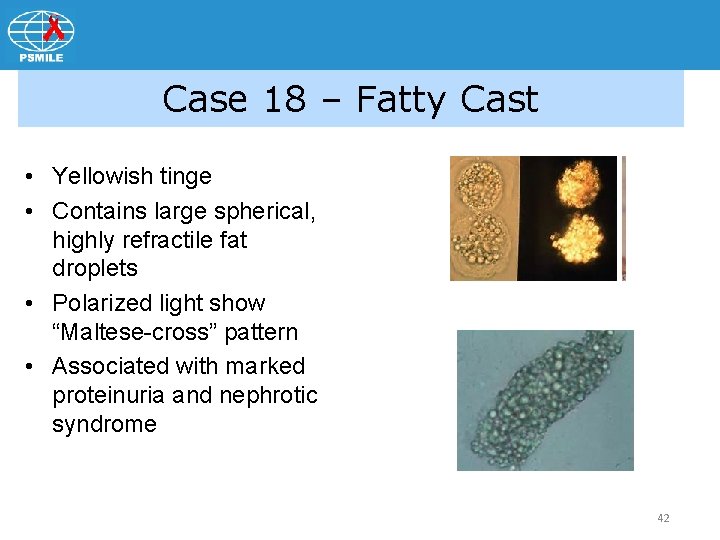 Case 18 – Fatty Cast • Yellowish tinge • Contains large spherical, highly refractile