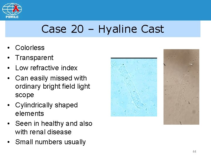 Case 20 – Hyaline Cast • • Colorless Transparent Low refractive index Can easily