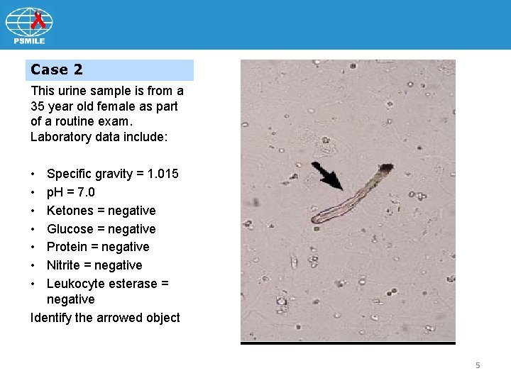 Case 2 This urine sample is from a 35 year old female as part