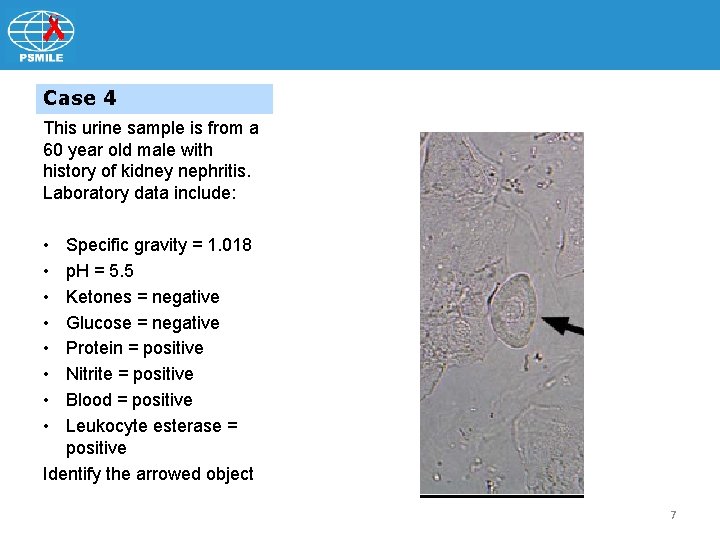 Case 4 This urine sample is from a 60 year old male with history