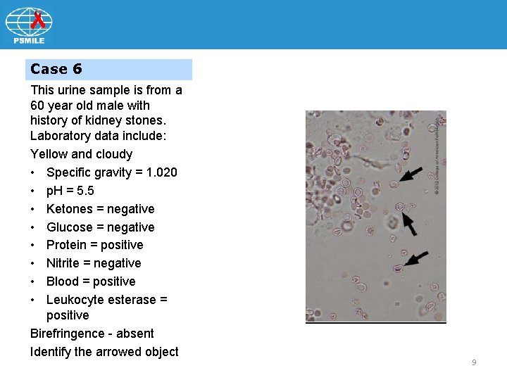Case 6 This urine sample is from a 60 year old male with history