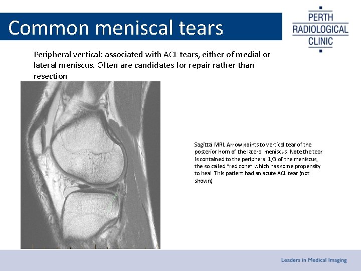 Common meniscal tears Peripheral vertical: associated with ACL tears, either of medial or lateral