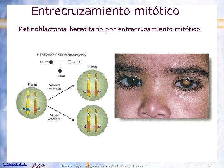 Entrecruzamiento mitótico Retinoblastoma hereditario por entrecruzamiento mitótico Dr. Antonio Barbadilla Tema 7: Ligamiento, entrecruzamiento