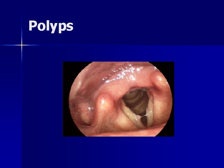 Polyps 