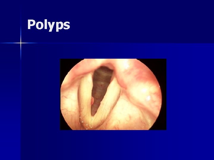 Polyps 